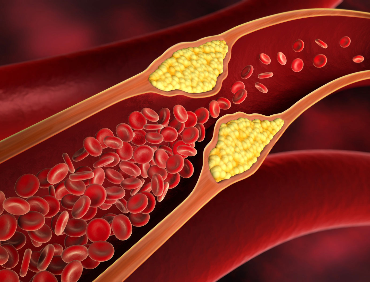 Arteriële thrombectomie en thrombolyse